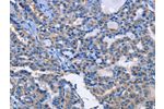 The image on the left is immunohistochemistry of paraffin-embedded Human thyroid cancer tissue using CSB-PA136137(ANXA4 Antibody) at dilution 1/20, on the right is treated with fusion protein. (Original magnification: 