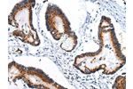 The image on the left is immunohistochemistry of paraffin-embedded Human colorectal cancer tissue using CSB-PA137594(ARFGAP2 Antibody) at dilution 1/25, on the right is treated with synthetic peptide. (Original magnification: 