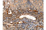 The image on the left is immunohistochemistry of paraffin-embedded Human cervical cancer tissue using CSB-PA137629(AIFM3 Antibody) at dilution 1/50, on the right is treated with fusion protein. (Original magnification: 