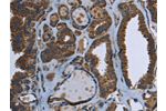 The image on the left is immunohistochemistry of paraffin-embedded Human thyroid cancer tissue using CSB-PA138466(GCK Antibody) at dilution 1/40, on the right is treated with fusion protein. (Original magnification: 