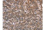 The image on the left is immunohistochemistry of paraffin-embedded Human liver cancer tissue using CSB-PA139252(FAAH2 Antibody) at dilution 1/30, on the right is treated with fusion protein. (Original magnification: 
