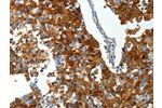 The image on the left is immunohistochemistry of paraffin-embedded Human breast cancer tissue using CSB-PA139278(ABCG1 Antibody) at dilution 1/25, on the right is treated with synthetic peptide. (Original magnification: 