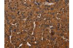 The image on the left is immunohistochemistry of paraffin-embedded Human liver cancer tissue using CSB-PA140004(CYBB Antibody) at dilution 1/50, on the right is treated with synthetic peptide. (Original magnification: 