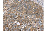 The image on the left is immunohistochemistry of paraffin-embedded Human cervical cancer tissue using CSB-PA140740(CENPO Antibody) at dilution 1/40, on the right is treated with fusion protein. (Original magnification: 