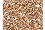 The image on the left is immunohistochemistry of paraffin-embedded Human thyroid cancer tissue using CSB-PA140978(DDX4 Antibody) at dilution 1/40, on the right is treated with synthetic peptide. (Original magnification: 