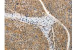 The image on the left is immunohistochemistry of paraffin-embedded Human liver cancer tissue using CSB-PA141929(ADIPOR2 Antibody) at dilution 1/20, on the right is treated with synthetic peptide. (Original magnification: 