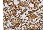 The image on the left is immunohistochemistry of paraffin-embedded Human thyroid cancer tissue using CSB-PA143153(CMTM8 Antibody) at dilution 1/40, on the right is treated with synthetic peptide. (Original magnification: 