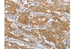 The image on the left is immunohistochemistry of paraffin-embedded Human gastic cancer tissue using CSB-PA143333(FARSB Antibody) at dilution 1/20, on the right is treated with fusion protein. (Original magnification: 