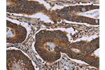 The image on the left is immunohistochemistry of paraffin-embedded Human colon cancer tissue using CSB-PA143390(FHIT Antibody) at dilution 1/30, on the right is treated with fusion protein. (Original magnification: 