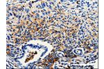 The image on the left is immunohistochemistry of paraffin-embedded Human lung cancer tissue using CSB-PA144023(CTSZ Antibody) at dilution 1/25, on the right is treated with fusion protein. (Original magnification: 