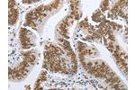 The image on the left is immunohistochemistry of paraffin-embedded Human colon cancer tissue using CSB-PA144058(LMNA Antibody) at dilution 1/70, on the right is treated with fusion protein. (Original magnification: 