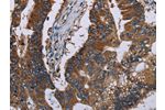 The image on the left is immunohistochemistry of paraffin-embedded Human colon cancer tissue using CSB-PA144936(CLDND1 Antibody) at dilution 1/40, on the right is treated with fusion protein. (Original magnification: 