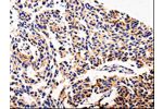 The image on the left is immunohistochemistry of paraffin-embedded Human lung cancer tissue using CSB-PA145342(AFP Antibody) at dilution 1/20, on the right is treated with fusion protein. (Original magnification: 
