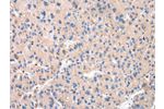 The image on the left is immunohistochemistry of paraffin-embedded Human liver cancer tissue using CSB-PA145433(CTSK Antibody) at dilution 1/20, on the right is treated with synthetic peptide. (Original magnification: 