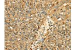 The image on the left is immunohistochemistry of paraffin-embedded Human breast cancer tissue using CSB-PA145926(CTSH Antibody) at dilution 1/50, on the right is treated with fusion protein. (Original magnification: 