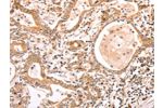 The image on the left is immunohistochemistry of paraffin-embedded Human gastic cancer tissue using CSB-PA146685(ABCF1 Antibody) at dilution 1/40, on the right is treated with fusion protein. (Original magnification: 