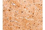 The image on the left is immunohistochemistry of paraffin-embedded Human brain tissue using CSB-PA147566(FABP7 Antibody) at dilution 1/22, on the right is treated with fusion protein. (Original magnification: 