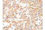 The image on the left is immunohistochemistry of paraffin-embedded Human breast cancer tissue using CSB-PA147820(F13A1 Antibody) at dilution 1/80, on the right is treated with synthetic peptide. (Original magnification: 