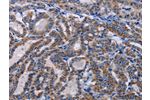 The image on the left is immunohistochemistry of paraffin-embedded Human thyroid cancer tissue using CSB-PA147947(GNAS Antibody) at dilution 1/20, on the right is treated with fusion protein. (Original magnification: 