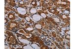 The image on the left is immunohistochemistry of paraffin-embedded Human thyroid cancer tissue using CSB-PA148821(FABP3 Antibody) at dilution 1/40, on the right is treated with synthetic peptide. (Original magnification: 