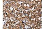 The image on the left is immunohistochemistry of paraffin-embedded Human thyroid cancer tissue using CSB-PA149291(CD27 Antibody) at dilution 1/60, on the right is treated with fusion protein. (Original magnification: 