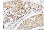 The image on the left is immunohistochemistry of paraffin-embedded Human breast cancer tissue using CSB-PA149552(ABHD5 Antibody) at dilution 1/15, on the right is treated with fusion protein. (Original magnification: 