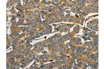 The image on the left is immunohistochemistry of paraffin-embedded Human breast cancer tissue using CSB-PA149571(AIF1 Antibody) at dilution 1/40, on the right is treated with fusion protein. (Original magnification: 