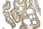 The image on the left is immunohistochemistry of paraffin-embedded Human thyroid cancer tissue using CSB-PA149991(CHGA  Antibody) at dilution 1/35, on the right is treated with synthetic peptide. (Original magnification: 