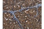 The image on the left is immunohistochemistry of paraffin-embedded Human ovarian cancer tissue using CSB-PA150016(CERS6 Antibody) at dilution 1/35, on the right is treated with synthetic peptide. (Original magnification: 