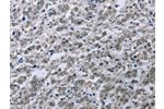 The image on the left is immunohistochemistry of paraffin-embedded Human liver cancer tissue using CSB-PA150749(FES Antibody) at dilution 1/35, on the right is treated with fusion protein. (Original magnification: 