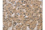 The image on the left is immunohistochemistry of paraffin-embedded Human liver cancer tissue using CSB-PA151075(DDIT4 Antibody) at dilution 1/30, on the right is treated with fusion protein. (Original magnification: 