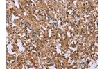 The image on the left is immunohistochemistry of paraffin-embedded Human thyroid cancer tissue using CSB-PA151107(FGFR2 Antibody) at dilution 1/20, on the right is treated with synthetic peptide. (Original magnification: 