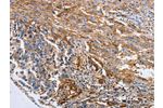 The image on the left is immunohistochemistry of paraffin-embedded Human liver cancer tissue using CSB-PA151172(CD151 Antibody) at dilution 1/10, on the right is treated with fusion protein. (Original magnification: 