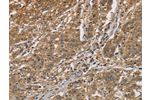 The image is immunohistochemistry of paraffin-embedded Human gastic cancer tissue using CSB-PA151289(CKMT2 Antibody) at dilution 1/60. (Original magnification: 