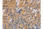 The image on the left is immunohistochemistry of paraffin-embedded Human liver cancer tissue using CSB-PA151323(EDN3 Antibody) at dilution 1/40, on the right is treated with fusion protein. (Original magnification: 