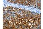 The image on the left is immunohistochemistry of paraffin-embedded Human liver cancer tissue using CSB-PA151772(ANXA13 Antibody) at dilution 1/40, on the right is treated with fusion protein. (Original magnification: 