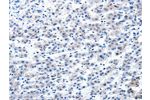 The image on the left is immunohistochemistry of paraffin-embedded Human liver cancer tissue using CSB-PA151818(AIMP2 Antibody) at dilution 1/25, on the right is treated with fusion protein. (Original magnification: 