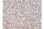 The image on the left is immunohistochemistry of paraffin-embedded Human prostate cancer tissue using CSB-PA152490(FGF6 Antibody) at dilution 1/30, on the right is treated with synthetic peptide. (Original magnification: 