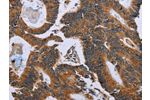 The image on the left is immunohistochemistry of paraffin-embedded Human colon cancer tissue using CSB-PA153165(GH2 Antibody) at dilution 1/60, on the right is treated with fusion protein. (Original magnification: 