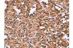 The image on the left is immunohistochemistry of paraffin-embedded Human thyroid cancer tissue using CSB-PA153505(DKK4 Antibody) at dilution 1/20, on the right is treated with fusion protein. (Original magnification: 