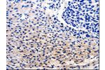 The image on the left is immunohistochemistry of paraffin-embedded Human liver cancer tissue using CSB-PA153558(CDC20 Antibody) at dilution 1/25, on the right is treated with fusion protein. (Original magnification: 