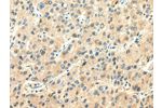 The image on the left is immunohistochemistry of paraffin-embedded Human liver cancer tissue using CSB-PA153836(CHGA  Antibody) at dilution 1/20, on the right is treated with synthetic peptide. (Original magnification: 