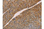 The image on the left is immunohistochemistry of paraffin-embedded Human liver cancer tissue using CSB-PA153859(FGL1 Antibody) at dilution 1/50, on the right is treated with fusion protein. (Original magnification: 