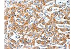 The image on the left is immunohistochemistry of paraffin-embedded Human breast cancer tissue using CSB-PA154373(AFAP1 Antibody) at dilution 1/20, on the right is treated with fusion protein. (Original magnification: 