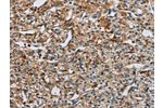 The image on the left is immunohistochemistry of paraffin-embedded Human prostate cancer tissue using CSB-PA154507(EIF2AK3 Antibody) at dilution 1/50, on the right is treated with synthetic peptide. (Original magnification: 