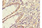 Immunohistochemistry of paraffin-embedded CSB-PA15499A0Rb using human colon cancer at dilution 1:100