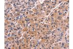The image on the left is immunohistochemistry of paraffin-embedded Human liver cancer tissue using CSB-PA155590(COL20A1 Antibody) at dilution 1/30, on the right is treated with fusion protein. (Original magnification: 