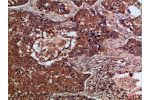Immunohistochemical analysis of paraffin-embedded Human-lung-cancer, antibody was diluted at 1:100