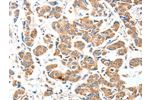 The image on the left is immunohistochemistry of paraffin-embedded Human breast cancer tissue using CSB-PA156662(AEBP2 Antibody) at dilution 1/25, on the right is treated with fusion protein. (Original magnification: 