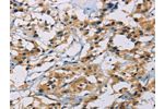 The image on the left is immunohistochemistry of paraffin-embedded Human thyroid cancer tissue using CSB-PA156748(CSNK1E Antibody) at dilution 1/30, on the right is treated with fusion protein. (Original magnification: 